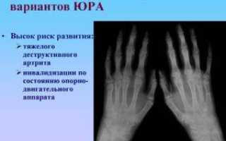 От чего зависит прогноз при ревматоидном артрите
