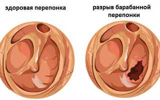 Антибиотики для лечения отита среднего уха: рекомендации и советы