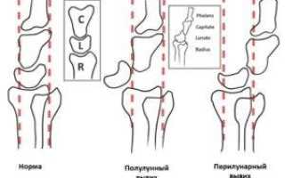 Вывих лучезапястного сустава