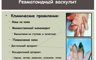 Как правильно и эффективно лечить ревматоидный артрит