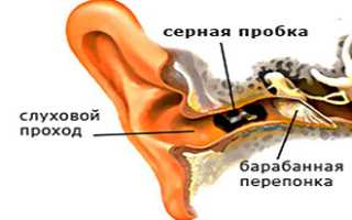 Удаление серных пробок перекисью водорода в домашних условиях