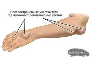 Что такое артрит коленного сустава у детей и как его лечить?