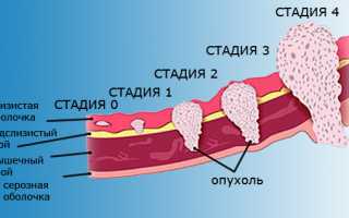 Плоскоклеточный рак гортани: причины и симптомы