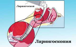 Лечение острого ларингита у ребенка: советы и рекомендации