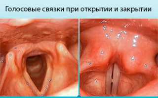Причины и лечение потери голоса: советы и рекомендации