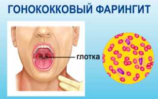 Симптомы и лечение гонококкового фарингита: важные аспекты здоровья
