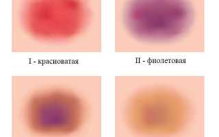 Гематома на колене: причины и лечение