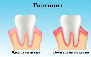 Как лечить хронический ларингит в домашних условиях