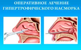 Способы лечения гипертрофического насморка хронической формы у взрослых
