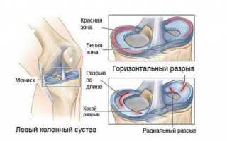 Восстановление после артроскопии коленного сустава мениска