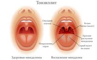 Причины возникновения тонзилитных пробок у взрослых