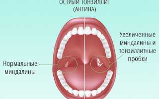 Диагностика и лечение гнойного тонзиллита у взрослых и детей