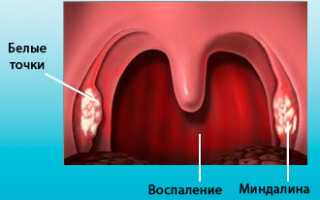 Как хронический фарингит влияет на слух и здоровье