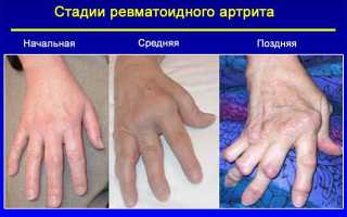 Рентген описание кистей при ревматоидном артрите