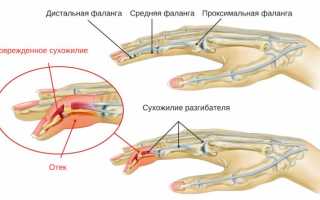 Как восстановить сухожилие на руке?