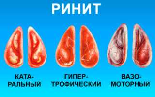 Классификация и клинические признаки острого насморка: важные аспекты и рекомендации