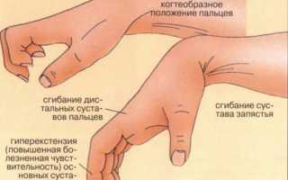 Вывих и как его лечить
