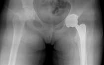 Подвывих эндопротеза тазобедренного сустава симптомы
