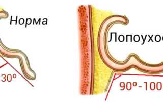 Лопоухость и методы избавления от нее: советы и рекомендации