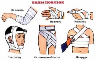 Как правильно накладывать разные виды повязок при переломе