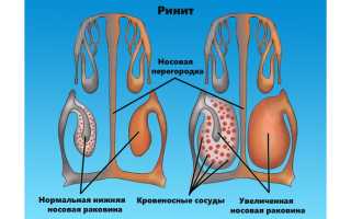 Признаки насморка и их особенности