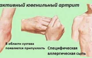 Мази при полиартрите суставов