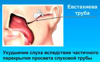 Симптомы и лечение гиперпластического ринита у взрослых