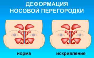 Лучшие способы лечения сухого ринита в домашних условиях