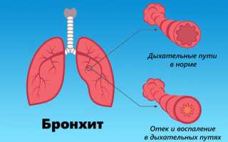 Как быстро вылечить детей от ринита в домашних условиях