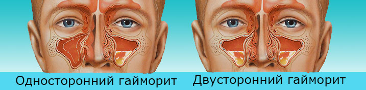 Воспаление носовых пазух