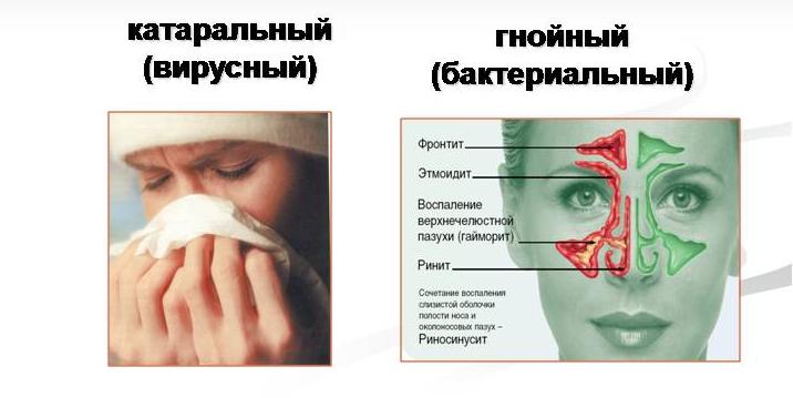 Виды острого синусита