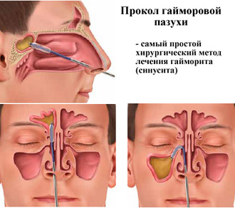 Схема прокола