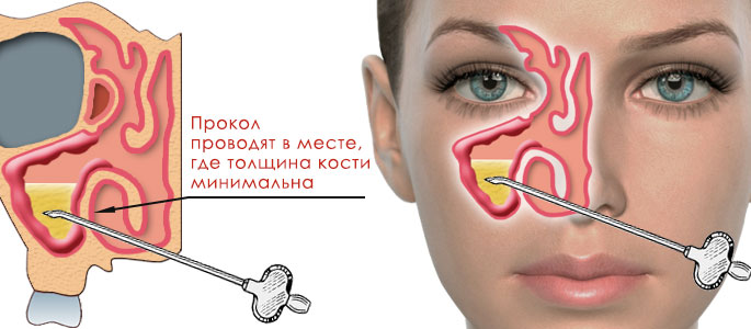 Прокол