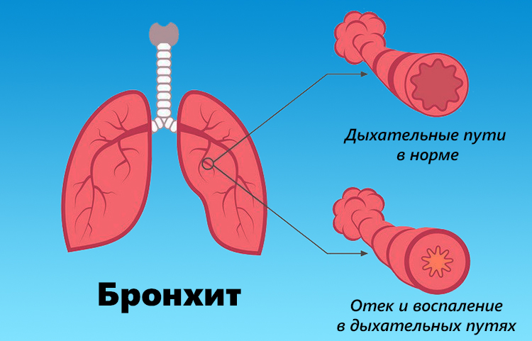 Бронхит
