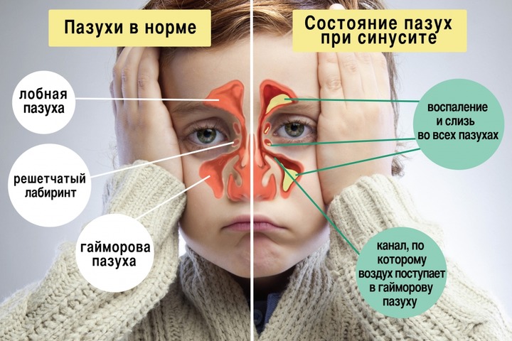 Синусит