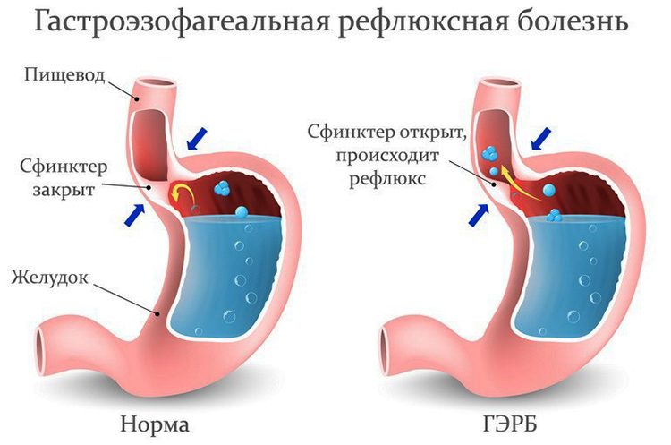 Гастроэзофагеальная рефлюксная болезнь