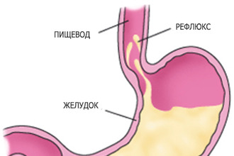 Рефлюкс-эзофагит