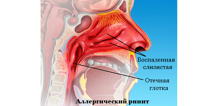Аллергический насморк