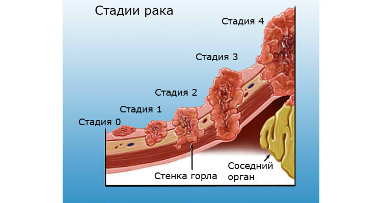 Стадии рака