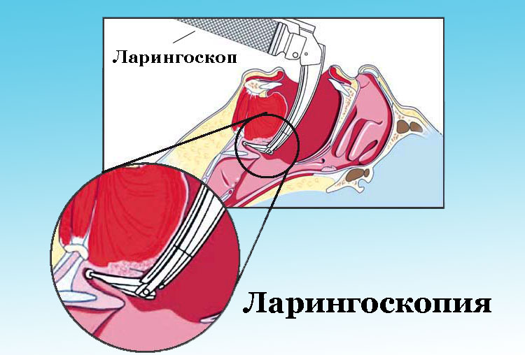 Ларингоскопия