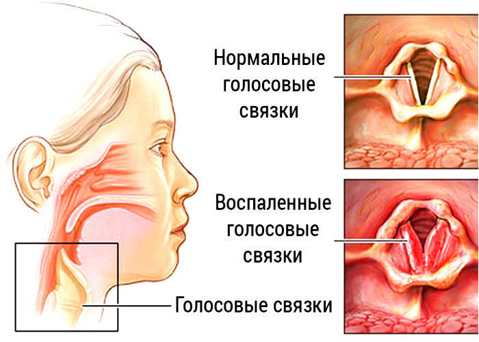Заболевания трахеи, связок
