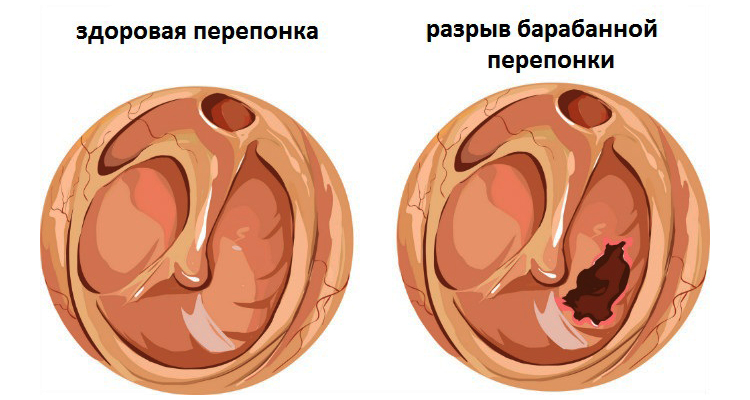 Перфорацией барабанной перепонки