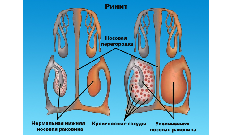 Ринит