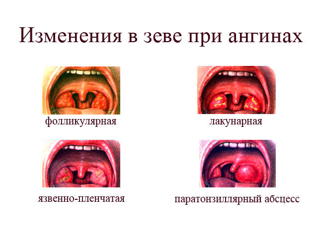 Ангины