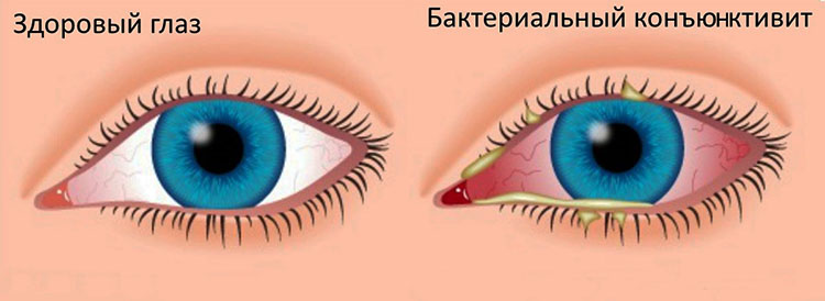 Воспаление слизистой глаза