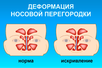 Искривление носовой перегородки