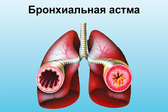 Бронхиальная астма