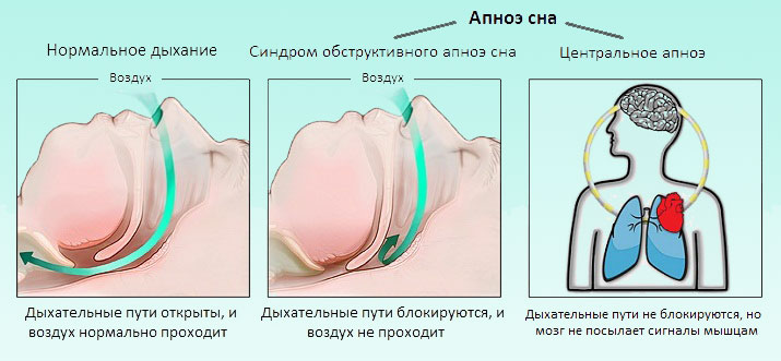 Схема апноэ