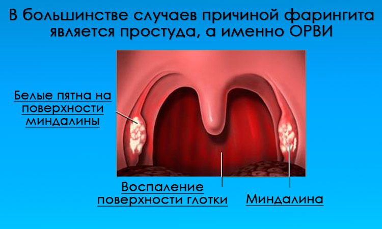 Фарингит