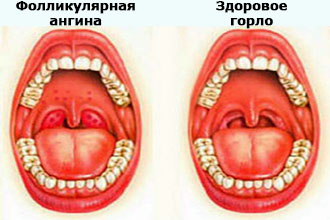 Фолликулярная ангина